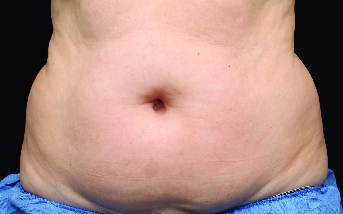 109-Female-Abdomen-DrBowes-Medium.jpg_0000_Before