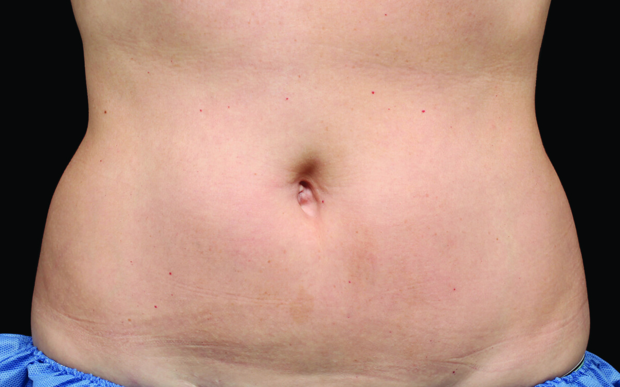 109-Female-Abdomen-DrBowes-Medium.jpg_0001_After