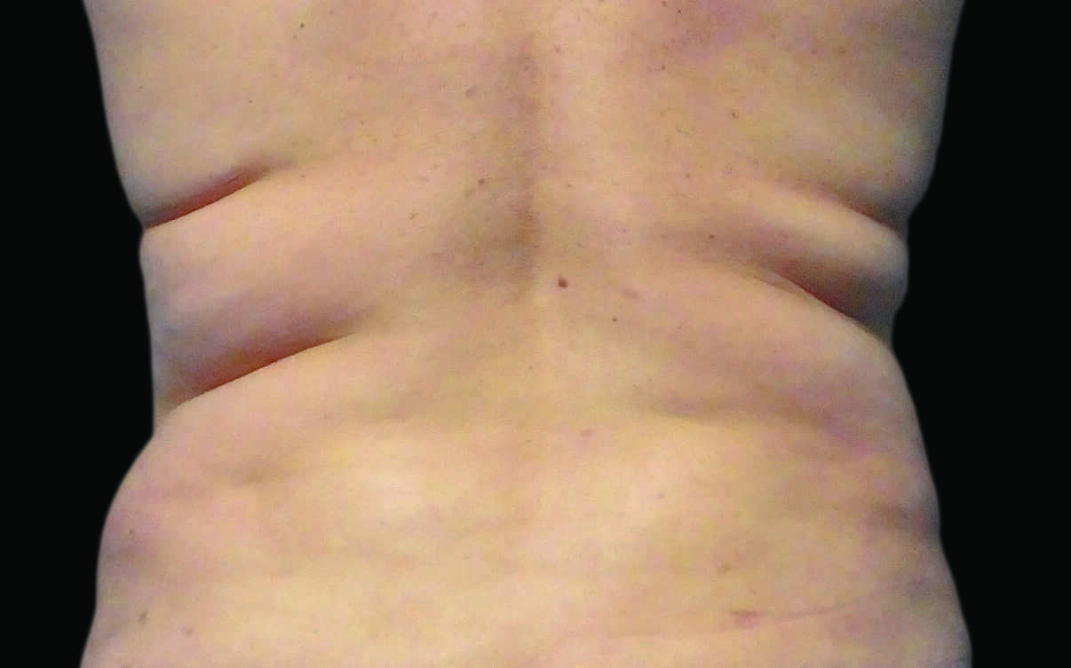 109-Female-Abdomen-DrBowes-Medium.jpg_0006_Before 109-Female-Abdomen-DrBowes-Medium.jpg_0006_Before