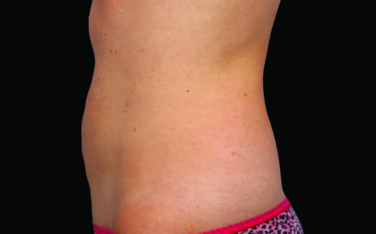 118-Female-Abdomen-DrStevens-Medium_After 118-Female-Abdomen-DrStevens-Medium_After