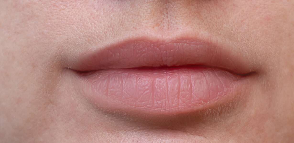 lips after fillers