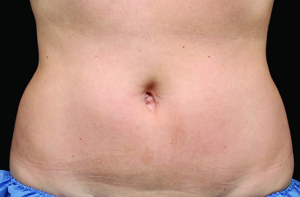 CoolSculpting Belly After