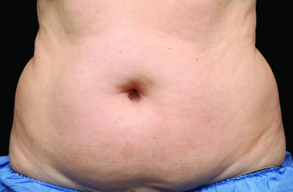 CoolSculpting belly before