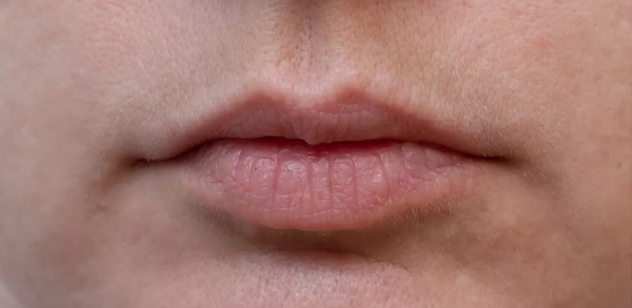 lips-before1-1.jpg