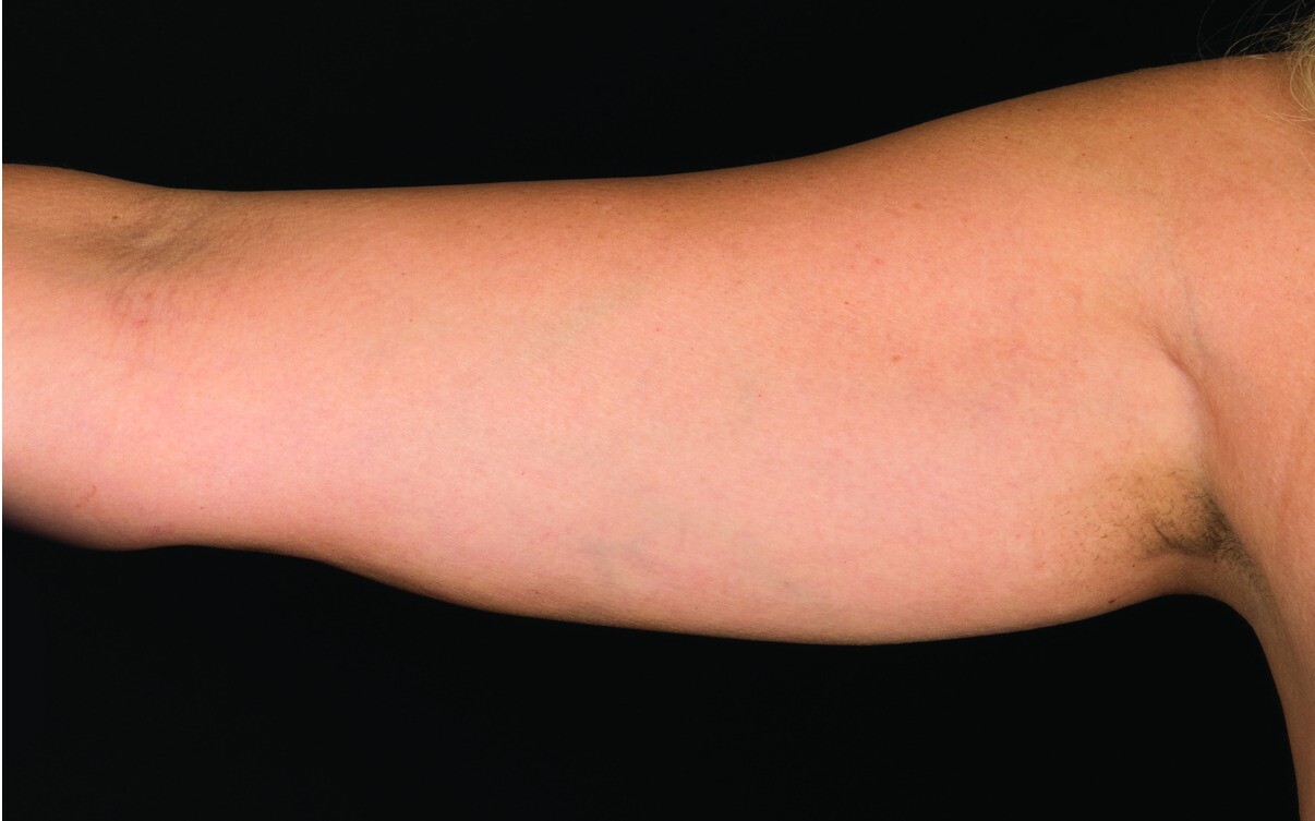 109-Female-Abdomen-DrBowes-Medium.jpg_0002_Before.jpg