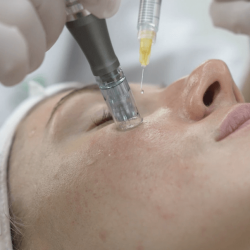 Prp & mesotherapy @ dna health corp2