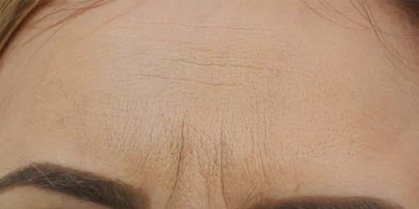 frown lines